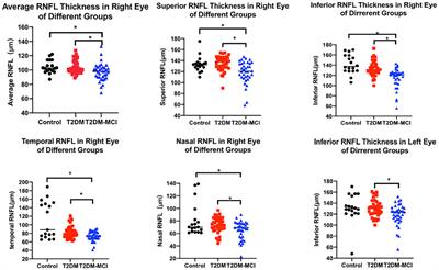 Correlation of mild cognitive impairment with the thickness of retinal nerve fiber layer and serum indicators in type 2 diabetic patients